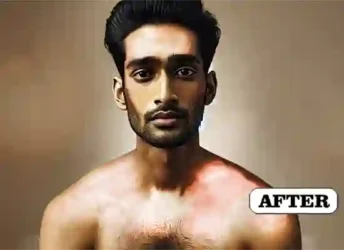 Dr VN Verma Best Homeopathy Doctor In Lucknow - Eczema Treatment After