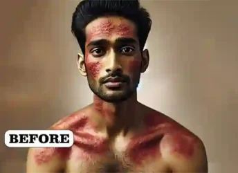 Dr VN Verma Best Homeopathy Doctor In Lucknow - Eczema Treatment Before