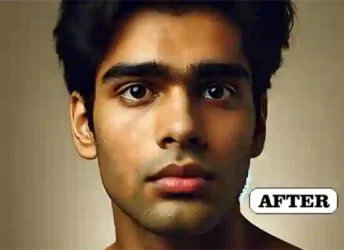 Dr VN Verma Best Homeopathy Doctor In Lucknow - Pimples Treatment After