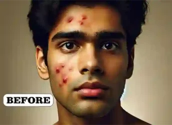 Dr VN Verma Best Homeopathy Doctor In Lucknow - Pimples Treatment Before